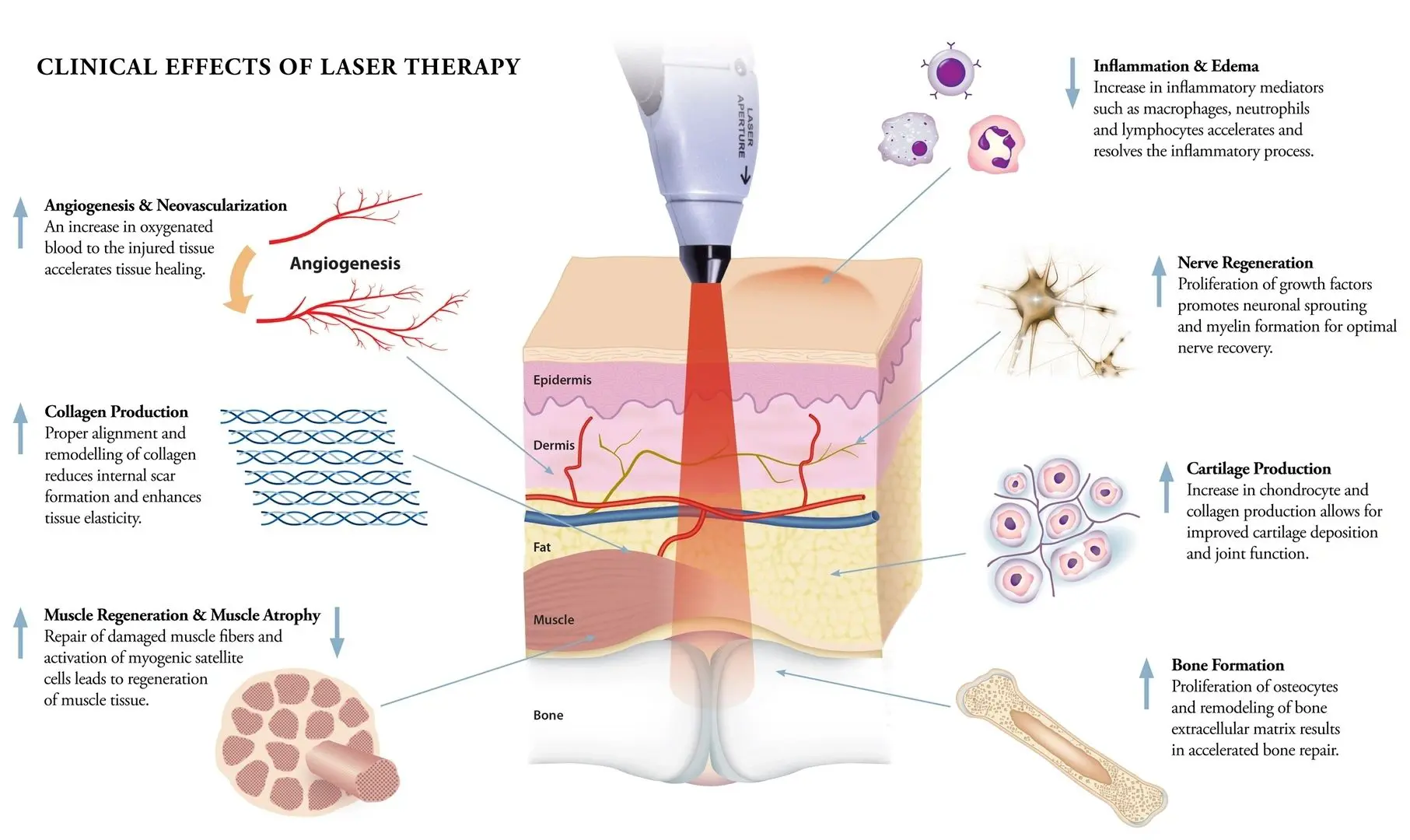 A diagram of the process of laser therapy.