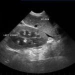 An ultasound image of a kidney and spleen.