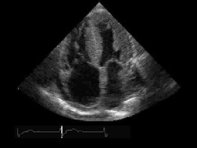 A picture of an ultrasound image of the right side of the heart.